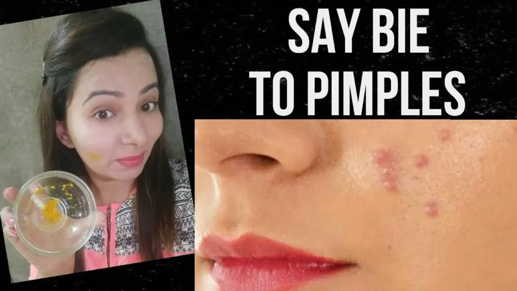 HOME REMEDIES TO TREAT ACNE OR PIMPLE NATURALLY
